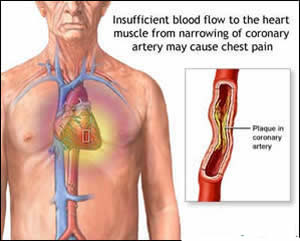 Coronary-Heart-Disease